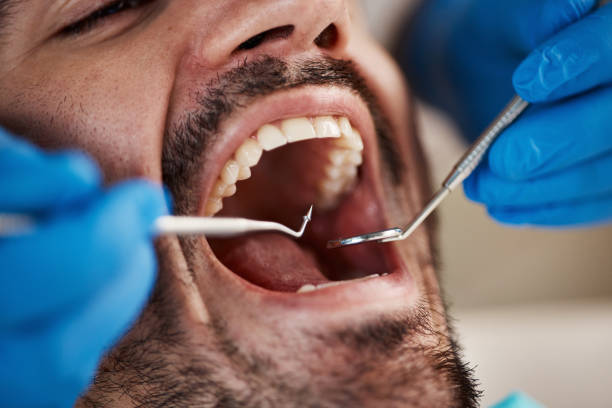 Best Emergency Wisdom Tooth Extraction in Keansburg, NJ